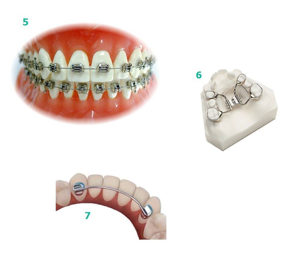 Аппарат хааса ортодонтия фото
